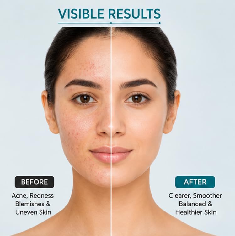 In Herb 15% Anti Acne Face Serum, Lightweight Daily Skincare Formula for Oily and Combination Skin Types, 30 ml