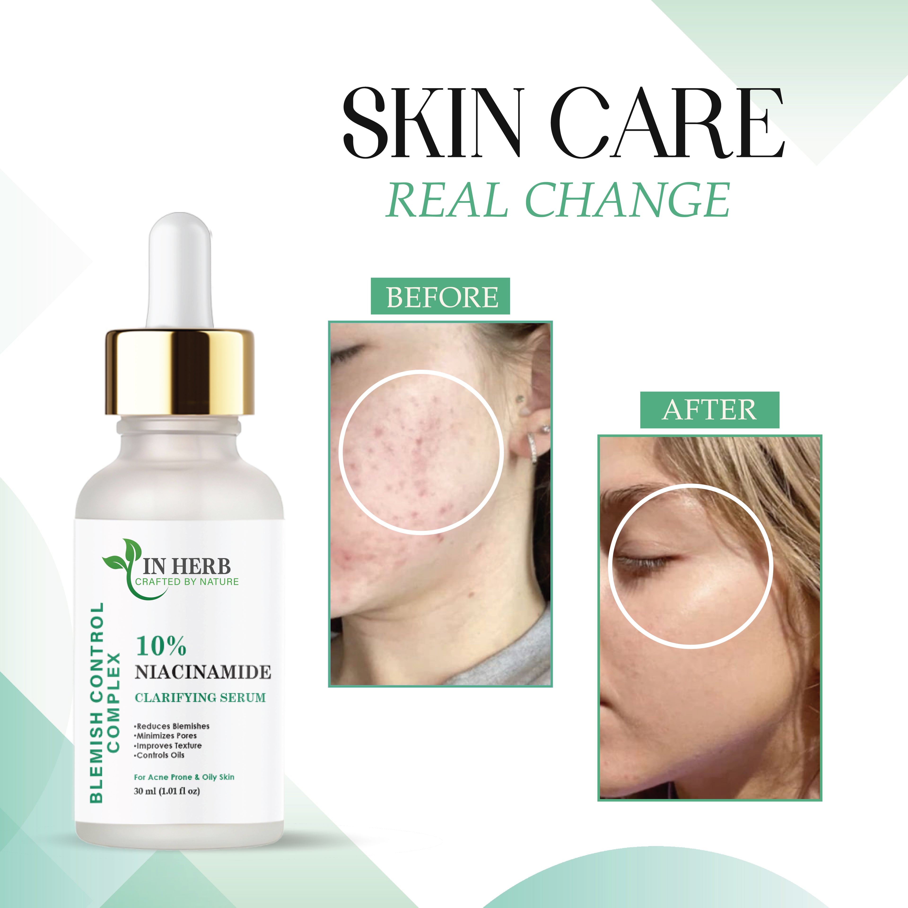 IN HERB Niacinamide 10% Serum, Reduces Blemishes & Acne Marks, 30ml