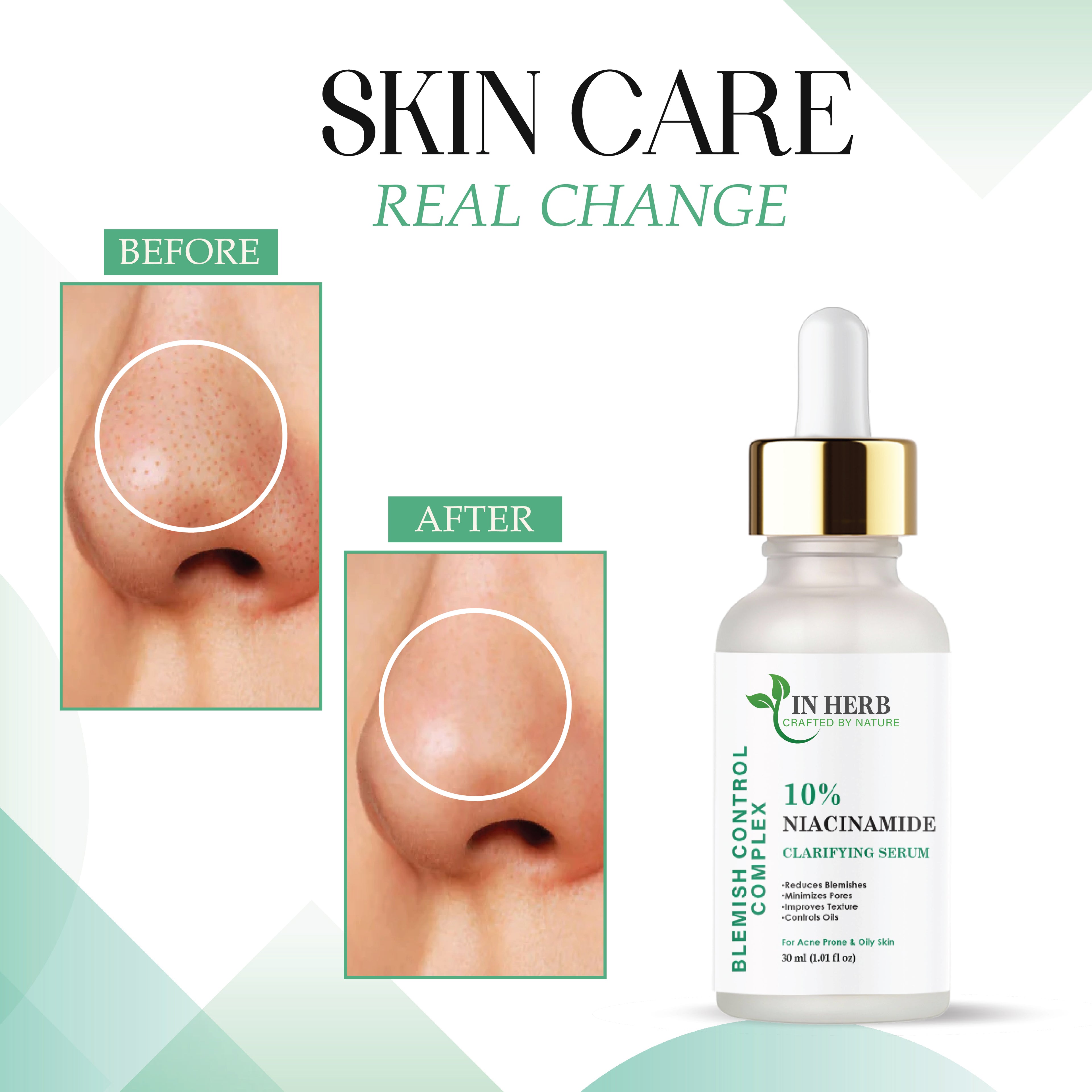 IN HERB Niacinamide 10% Serum, Reduces Blemishes & Acne Marks, 30ml